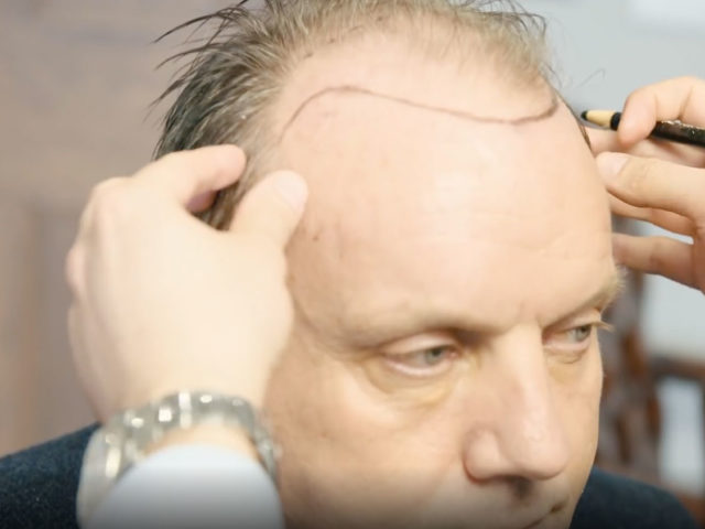 Hair transplant diary - The D’Souza Clinic