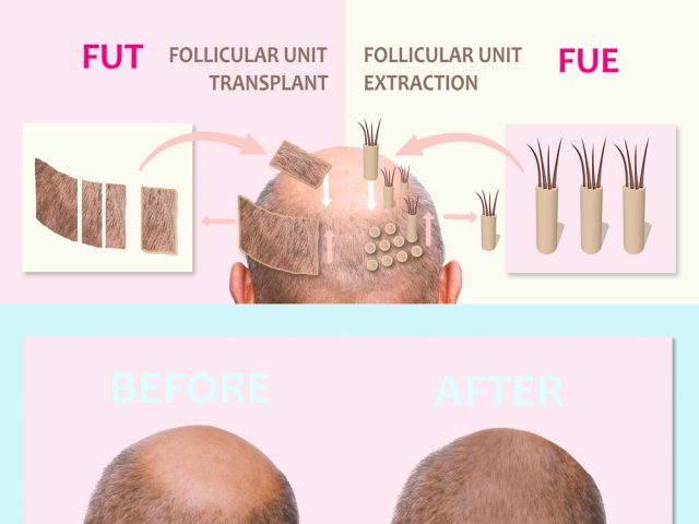 How Painful Are Hair Transplants?