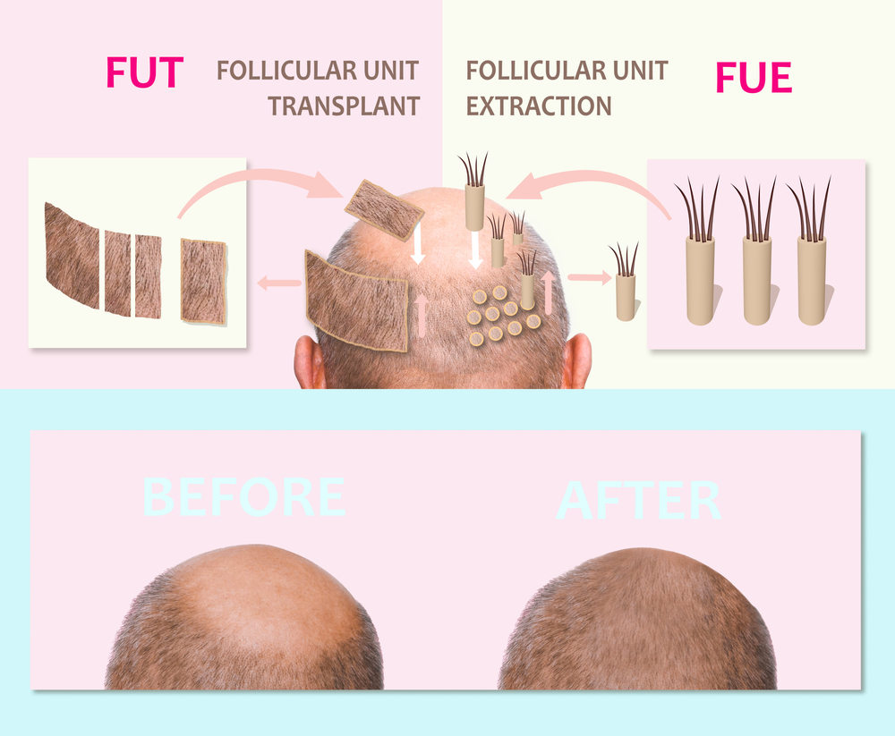 How Painful Are Hair Transplants?